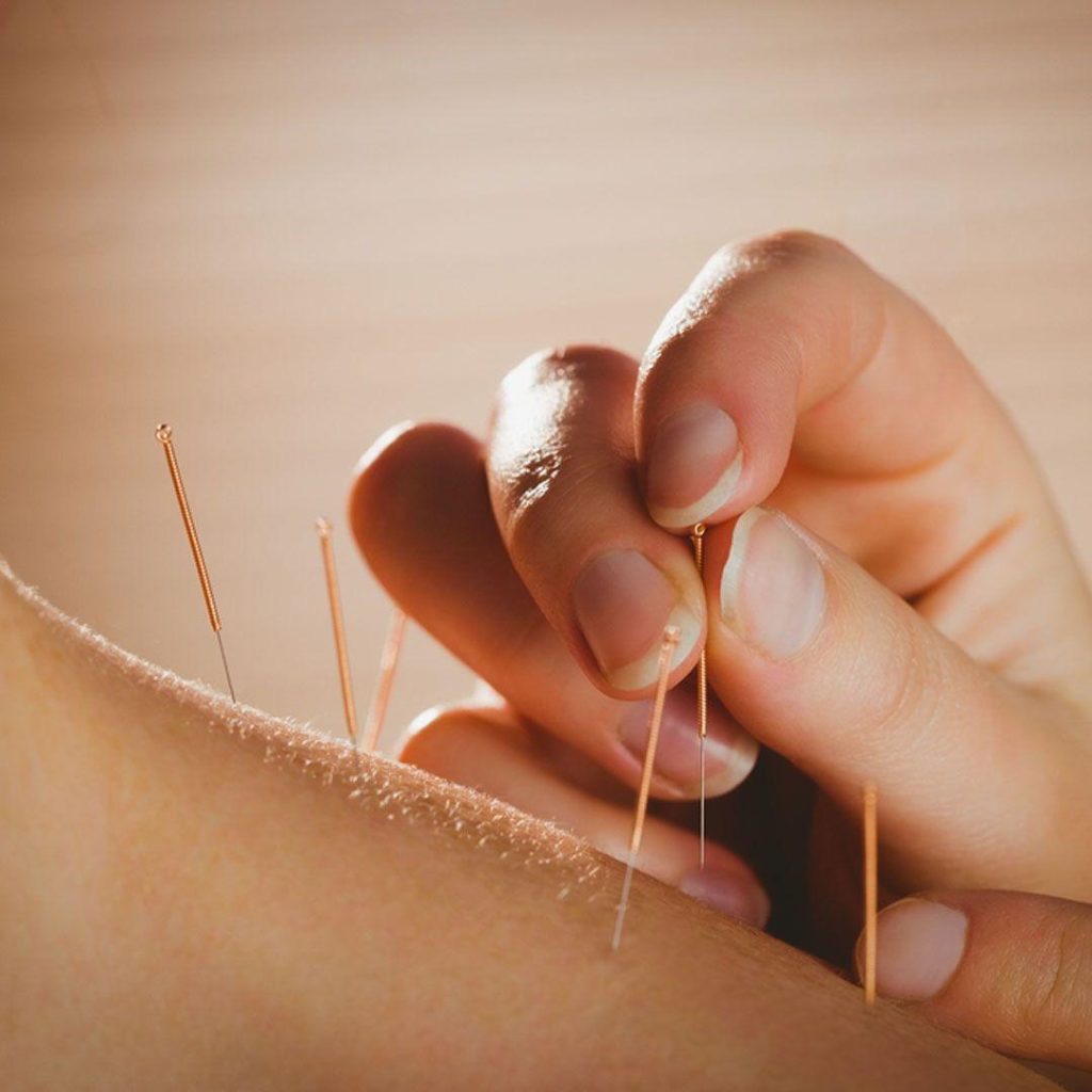 Accupuncture